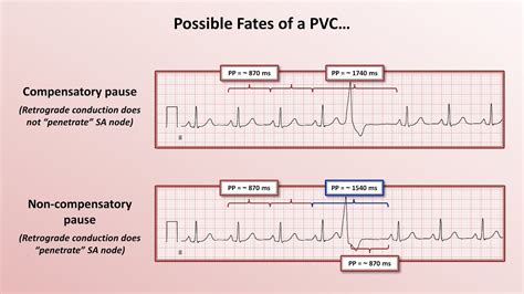 Advanced EKGs - PACs and PVCs (i.e. premature beats) - YouTube