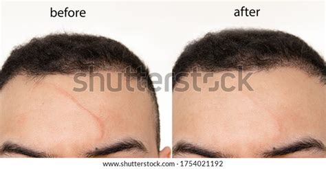 61 Scar Revision Images, Stock Photos & Vectors | Shutterstock