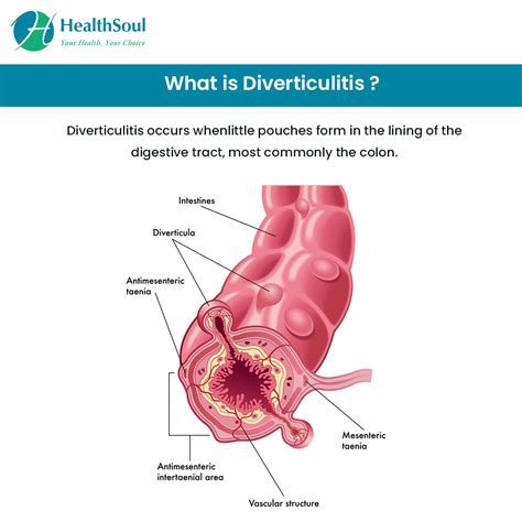 Diverticulitis – A Common Cause of Abdominal Pain after 40s – Healthsoul
