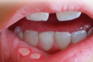 Stomatitis: What is it? Types, Symptoms, Causes and Treatments - Scope Heal