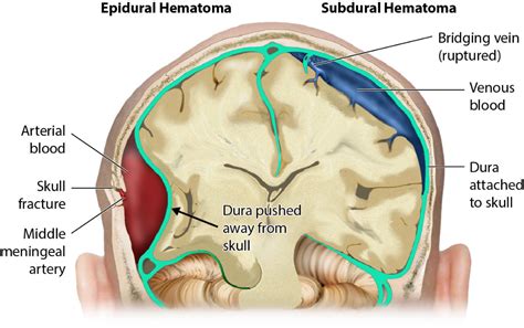 MCAT Memoranda — An epidural hematoma occurs after the traumatic... | Epidural hematoma ...