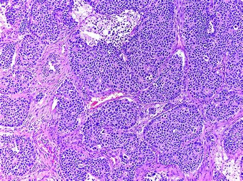 Pathology Outlines - Large cell neuroendocrine carcinoma