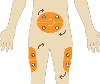 Subcutaneous Injection Sites - RheumDoctor