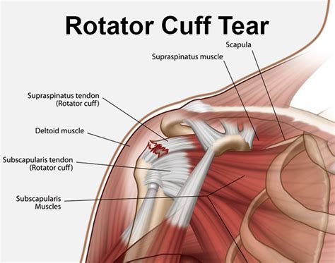Rotator Cuff Tear - Gold Coast Hand + Upper Limb Clinic