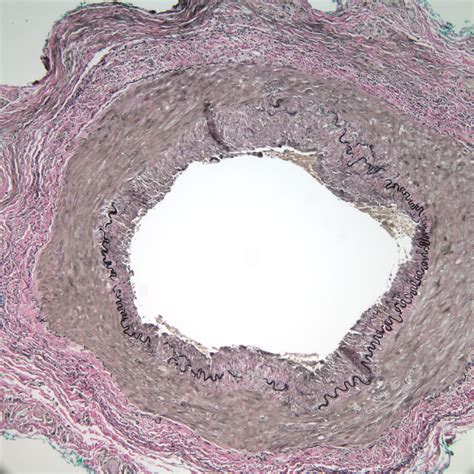 Case Example - Temporal Arteritis with Tongue Necrosis | Iowa Head and ...