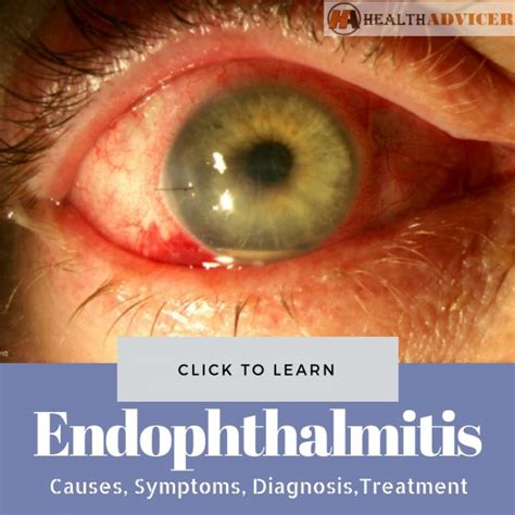 Endophthalmitis: Causes, Picture, Symptoms And Treatment