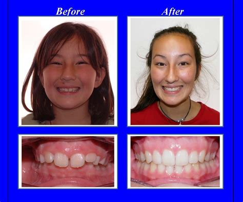 Teeth Gap Bands Before And After - Property & Real Estate for Rent