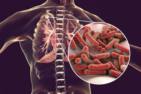 Secondary Tuberculosis in Lungs and Close-up View of Mycobacterium ...