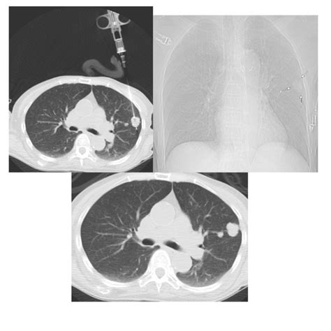 Biopsy and Personalized Medicine in Non-Small-Cell Lung Cancer (NSCLC) | Memorial Sloan ...