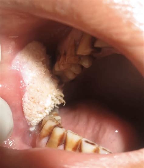 Filiform wart inside mouth : r/Warts