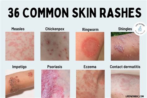 Skin Rashes Images