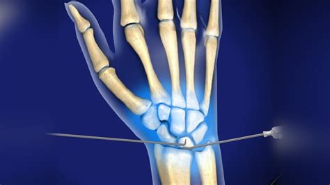 Wrist Arthroscopy | Aptiva Health