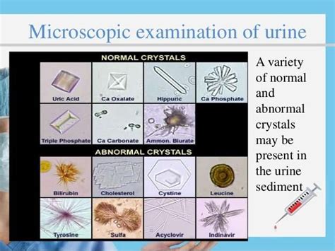 urine examination microscopically - Yahoo Image Search Results | Urinal, Medical technology ...