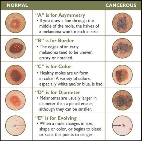 Skin Tag & Lesion Removal - Your Skin RN