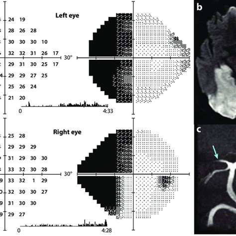 Left hemianopia with macular splitting. (a) A 62-year-old man with left... | Download Scientific ...