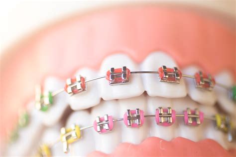 Metal Mouth? Not necessarily. | Meyer & Johns Dental Clinic