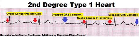 How to tell the Difference Between AV Heart Blocks 1 Degree, Wenckebach ...