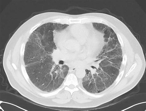 Hypersensitivity pneumonitis causes, symptoms, diagnosis, treatment & prognosis