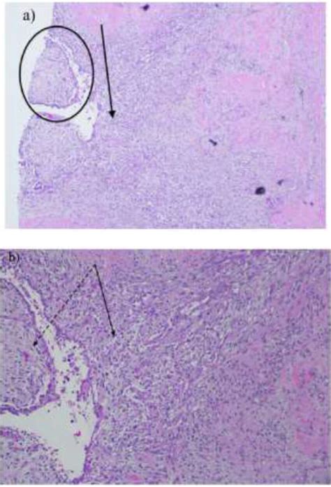 -Mastectomy Histology. (A) Low-power image (40x) malignant cellular ...