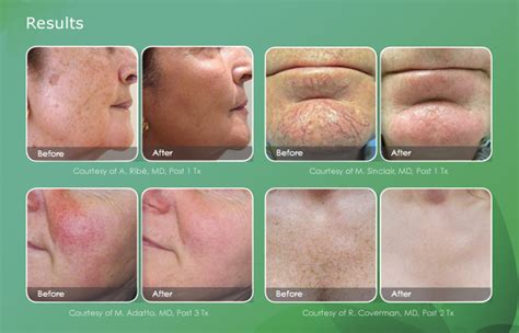 IPL Photofacial in Seattle WA - Advanced Dermatology and Laser Institute of Seattle