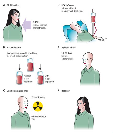 Autologous haematopoietic stem-cell transplantation in multiple sclerosis - The Lancet Neurology