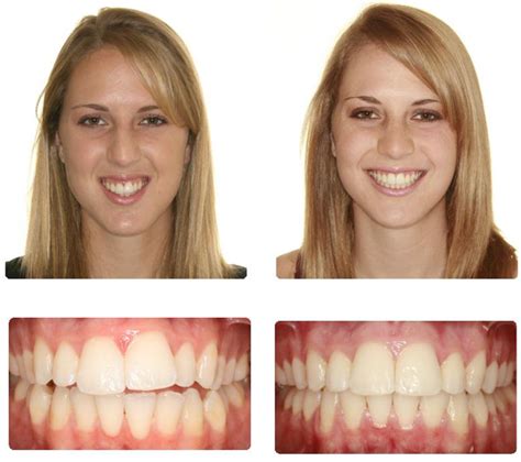 before-after-brace - G1 Dental Practice | NHS Dentist Glasgow City CentreG1 Dental Practice ...