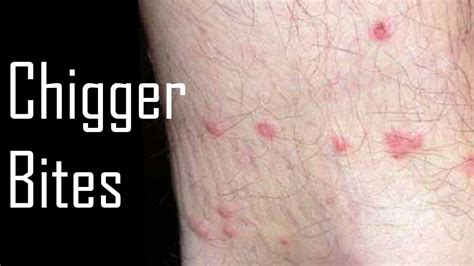 How to Get Rid of Chiggers?