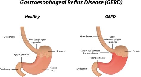 What Is The Difference Between Gerd And Acid Reflux Disease