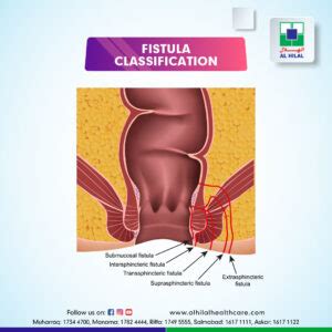 FISTULA-IN-ANO