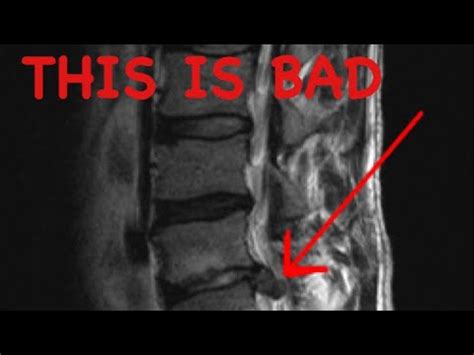 How to Read a Spine MRI - YouTube