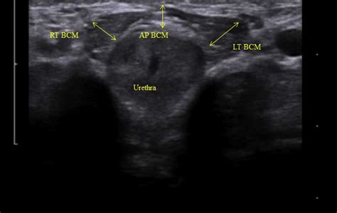 Pelvic Ultrasound For Men