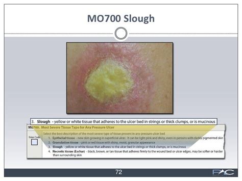 WoundRounds: Clinical Reimbursement and Wound Care webinar slides