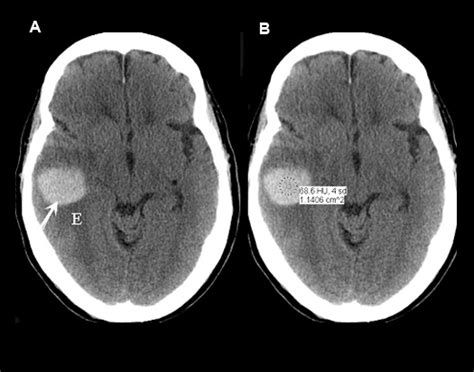 intracranial Hemorrhage