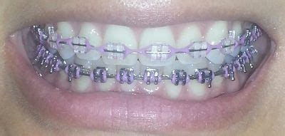 Currently in Braces After a Year - Brampton, ON | Cute braces colors, Dental braces, Cute braces