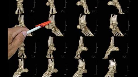 High ankle sprain vs. low ankle sprain: What are the key differences? - I Messenger