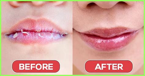 Dry and chapped lips are probably the most annoying thing. Worry not, a proper care is needed ...