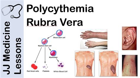 Polycythemia Rubra Vera | Pathophysiology, Symptoms, Diagnosis and ...