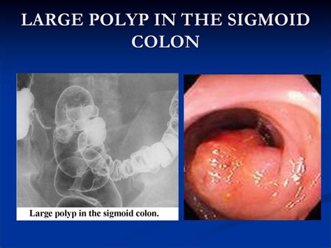 Colorectal cancer - презентация онлайн