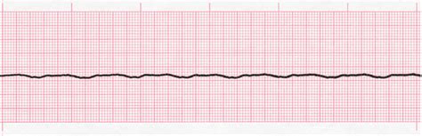 Level 1 - 1 - 10 - ECG - Memrise