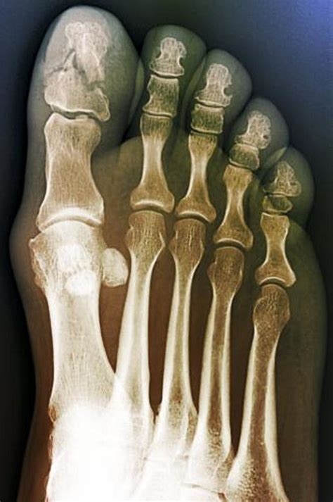 Image: Comminuted Fracture of the Great Toe - MSD Manual Professional ...