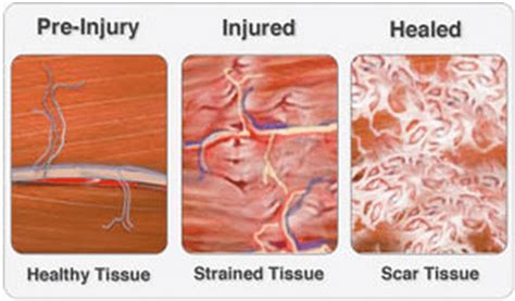 How to Prevent Muscle Strains • Stronger by Science