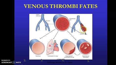 What is Thrombosis ? What is the fate of a thrombus? - YouTube