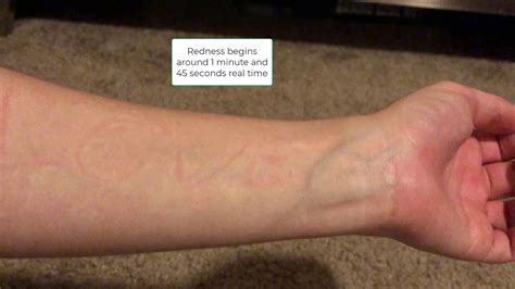 Dermatographia "skin writing disease" timelapse #shorts - YouTube