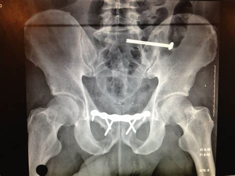 Pelvic Fractures - Low Energy - AdFrac