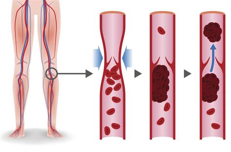 Blood clot behind knee: Symptoms, causes, and treatment