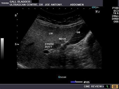 Normal Anatomy of Gall bladder | Ultrasound sonography, Ultrasound ...