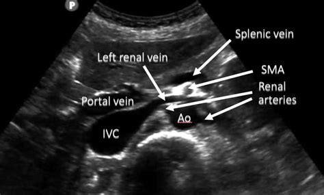 Aorta and IVC Ultrasound: Transverse Aorta Proximal to Distal