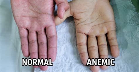 Anemia Rash Symptoms