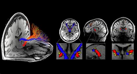 Human Cocaine and Heroin Addiction Is Found Tied to Impairments in Specific Brain Circuit ...