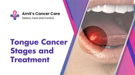 Tongue cancer- Symptoms Stages, Treatment |Dr Amit Chakraborty